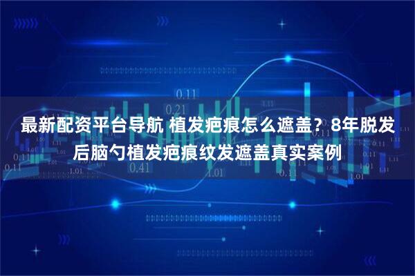 最新配资平台导航 植发疤痕怎么遮盖？8年脱发后脑勺植发疤痕纹发遮盖真实案例